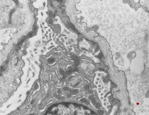  M,17y. | Alport syndrome - split and laminated basement membranes